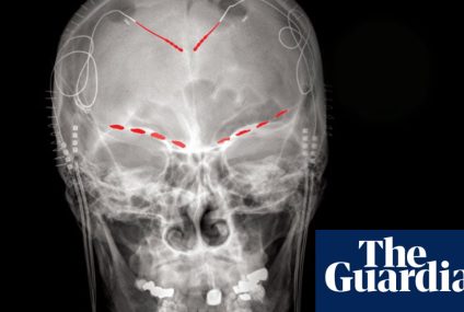 Oamenii de știință descoperă semnale cerebrale pentru durerea cronică – The Guardian