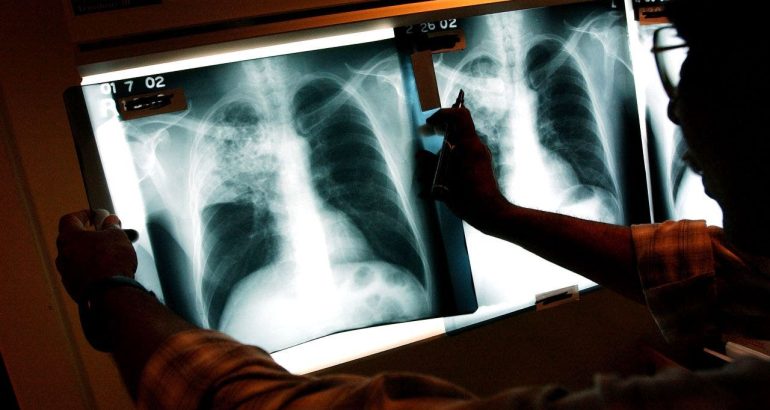 california-tuberculosis-outbreak-kills-1,-infects-14-as-officials-declare-health-emergency-–-fox-news